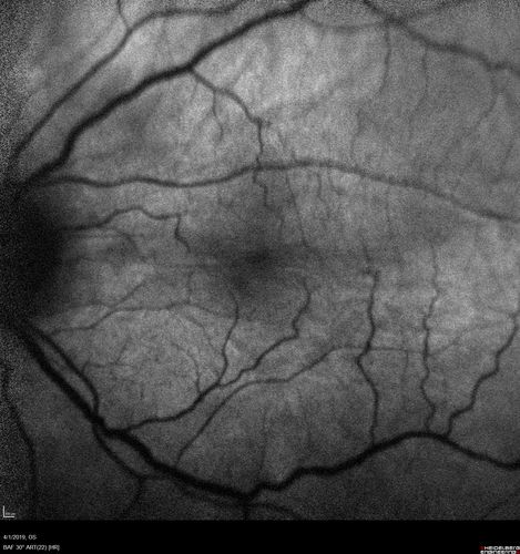 Posterior Scleritis - positive T-sign
62 year ols man was sick about 6 weeks ago and then 2 weeks ago the the left eye got red.  He was treated for conjunctivitis and the eye did not get better.  Topical steroids and oral non-steroidal anti-inflammatory medications did not help.  
VA OD: Dcc20/25 NccJ5
VA OS: Dcc5'/200 
The scleritis cleared within 2 weeks of starting high dose (80 mg) oral steroids.  Blood tests were all negative.
