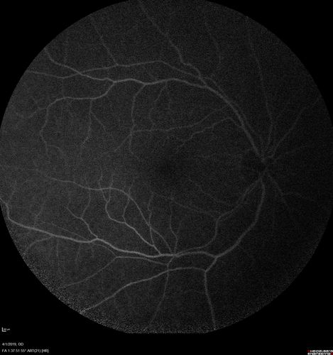 Posterior Scleritis - positive T-sign
62 year ols man was sick about 6 weeks ago and then 2 weeks ago the the left eye got red.  He was treated for conjunctivitis and the eye did not get better.  Topical steroids and oral non-steroidal anti-inflammatory medications did not help.  
VA OD: Dcc20/25 NccJ5
VA OS: Dcc5'/200 
The scleritis cleared within 2 weeks of starting high dose (80 mg) oral steroids.  Blood tests were all negative.
