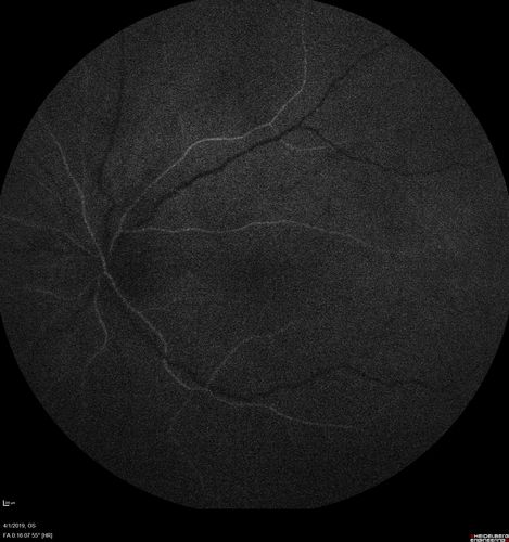 Posterior Scleritis - positive T-sign
62 year ols man was sick about 6 weeks ago and then 2 weeks ago the the left eye got red.  He was treated for conjunctivitis and the eye did not get better.  Topical steroids and oral non-steroidal anti-inflammatory medications did not help.  
VA OD: Dcc20/25 NccJ5
VA OS: Dcc5'/200 
The scleritis cleared within 2 weeks of starting high dose (80 mg) oral steroids.  Blood tests were all negative.
