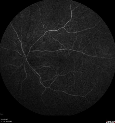 Posterior Scleritis - positive T-sign
62 year ols man was sick about 6 weeks ago and then 2 weeks ago the the left eye got red.  He was treated for conjunctivitis and the eye did not get better.  Topical steroids and oral non-steroidal anti-inflammatory medications did not help.  
VA OD: Dcc20/25 NccJ5
VA OS: Dcc5'/200 
The scleritis cleared within 2 weeks of starting high dose (80 mg) oral steroids.  Blood tests were all negative.
