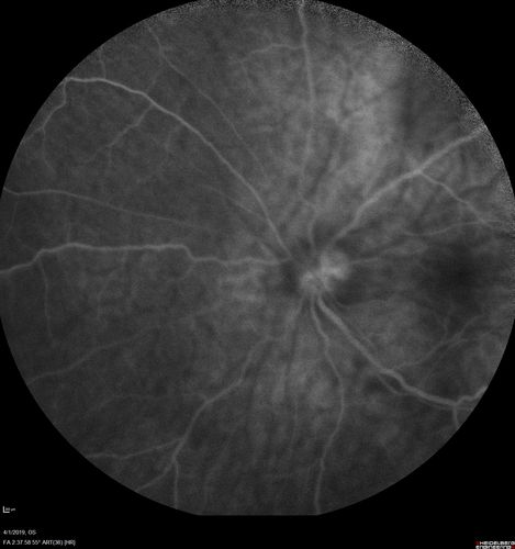 Posterior Scleritis - positive T-sign
62 year ols man was sick about 6 weeks ago and then 2 weeks ago the the left eye got red.  He was treated for conjunctivitis and the eye did not get better.  Topical steroids and oral non-steroidal anti-inflammatory medications did not help.  
VA OD: Dcc20/25 NccJ5
VA OS: Dcc5'/200 
The scleritis cleared within 2 weeks of starting high dose (80 mg) oral steroids.  Blood tests were all negative.
