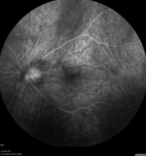 Posterior Scleritis - positive T-sign
62 year ols man was sick about 6 weeks ago and then 2 weeks ago the the left eye got red.  He was treated for conjunctivitis and the eye did not get better.  Topical steroids and oral non-steroidal anti-inflammatory medications did not help.  
VA OD: Dcc20/25 NccJ5
VA OS: Dcc5'/200 
The scleritis cleared within 2 weeks of starting high dose (80 mg) oral steroids.  Blood tests were all negative.
