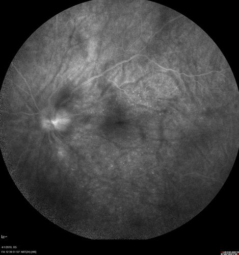 Posterior Scleritis - positive T-sign
62 year ols man was sick about 6 weeks ago and then 2 weeks ago the the left eye got red.  He was treated for conjunctivitis and the eye did not get better.  Topical steroids and oral non-steroidal anti-inflammatory medications did not help.  
VA OD: Dcc20/25 NccJ5
VA OS: Dcc5'/200 
The scleritis cleared within 2 weeks of starting high dose (80 mg) oral steroids.  Blood tests were all negative.
