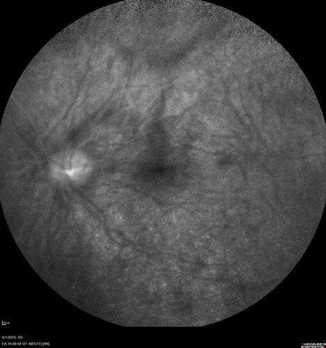 Posterior Scleritis - positive T-sign
62 year ols man was sick about 6 weeks ago and then 2 weeks ago the the left eye got red.  He was treated for conjunctivitis and the eye did not get better.  Topical steroids and oral non-steroidal anti-inflammatory medications did not help.  
VA OD: Dcc20/25 NccJ5
VA OS: Dcc5'/200 
The scleritis cleared within 2 weeks of starting high dose (80 mg) oral steroids.  Blood tests were all negative.
