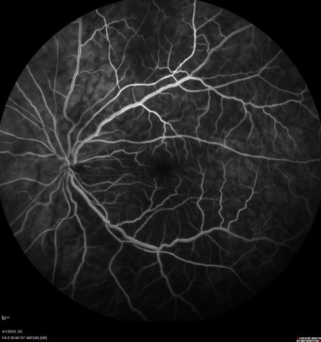 Posterior Scleritis - positive T-sign
62 year ols man was sick about 6 weeks ago and then 2 weeks ago the the left eye got red.  He was treated for conjunctivitis and the eye did not get better.  Topical steroids and oral non-steroidal anti-inflammatory medications did not help.  
VA OD: Dcc20/25 NccJ5
VA OS: Dcc5'/200 
The scleritis cleared within 2 weeks of starting high dose (80 mg) oral steroids.  Blood tests were all negative.
