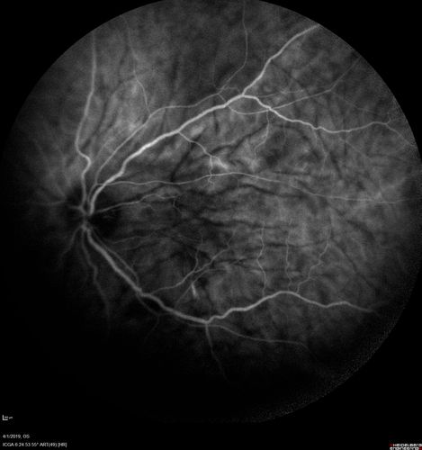 Posterior Scleritis - positive T-sign
62 year ols man was sick about 6 weeks ago and then 2 weeks ago the the left eye got red.  He was treated for conjunctivitis and the eye did not get better.  Topical steroids and oral non-steroidal anti-inflammatory medications did not help.  
VA OD: Dcc20/25 NccJ5
VA OS: Dcc5'/200 
The scleritis cleared within 2 weeks of starting high dose (80 mg) oral steroids.  Blood tests were all negative.

