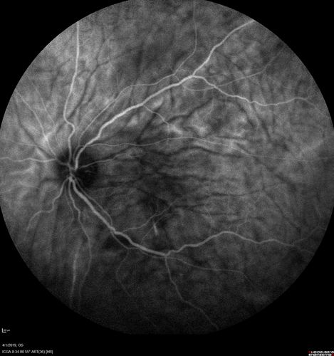 Posterior Scleritis - positive T-sign
62 year ols man was sick about 6 weeks ago and then 2 weeks ago the the left eye got red.  He was treated for conjunctivitis and the eye did not get better.  Topical steroids and oral non-steroidal anti-inflammatory medications did not help.  
VA OD: Dcc20/25 NccJ5
VA OS: Dcc5'/200 
The scleritis cleared within 2 weeks of starting high dose (80 mg) oral steroids.  Blood tests were all negative.
