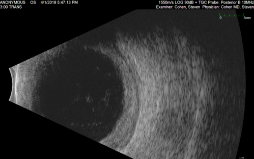 Posterior Scleritis - positive T-sign
62 year ols man was sick about 6 weeks ago and then 2 weeks ago the the left eye got red.  He was treated for conjunctivitis and the eye did not get better.  Topical steroids and oral non-steroidal anti-inflammatory medications did not help.  
VA OD: Dcc20/25 NccJ5
VA OS: Dcc5'/200 
The scleritis cleared within 2 weeks of starting high dose (80 mg) oral steroids.  Blood tests were all negative.
