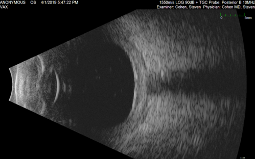 Posterior Scleritis - positive T-sign
62 year ols man was sick about 6 weeks ago and then 2 weeks ago the the left eye got red.  He was treated for conjunctivitis and the eye did not get better.  Topical steroids and oral non-steroidal anti-inflammatory medications did not help.  
VA OD: Dcc20/25 NccJ5
VA OS: Dcc5'/200 
The scleritis cleared within 2 weeks of starting high dose (80 mg) oral steroids.  Blood tests were all negative.
