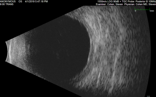 Posterior Scleritis - positive T-sign
62 year ols man was sick about 6 weeks ago and then 2 weeks ago the the left eye got red.  He was treated for conjunctivitis and the eye did not get better.  Topical steroids and oral non-steroidal anti-inflammatory medications did not help.  
VA OD: Dcc20/25 NccJ5
VA OS: Dcc5'/200 
The scleritis cleared within 2 weeks of starting high dose (80 mg) oral steroids.  Blood tests were all negative.
