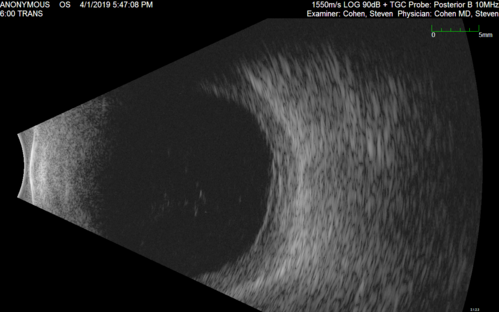 Posterior Scleritis - positive T-sign
62 year ols man was sick about 6 weeks ago and then 2 weeks ago the the left eye got red.  He was treated for conjunctivitis and the eye did not get better.  Topical steroids and oral non-steroidal anti-inflammatory medications did not help.  
VA OD: Dcc20/25 NccJ5
VA OS: Dcc5'/200 
The scleritis cleared within 2 weeks of starting high dose (80 mg) oral steroids.  Blood tests were all negative.

