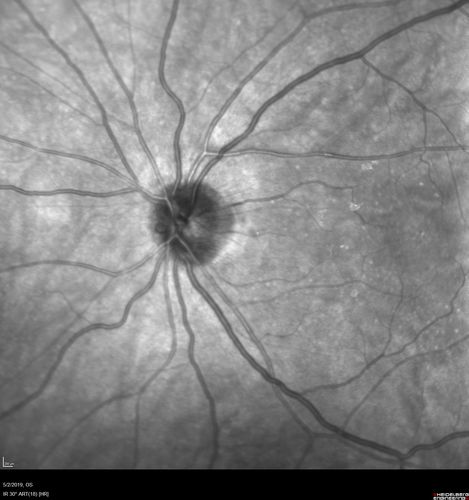 Posterior Scleritis - positive T-sign
62 year ols man was sick about 6 weeks ago and then 2 weeks ago the the left eye got red.  He was treated for conjunctivitis and the eye did not get better.  Topical steroids and oral non-steroidal anti-inflammatory medications did not help.  
VA OD: Dcc20/25 NccJ5
VA OS: Dcc5'/200 
The scleritis cleared within 2 weeks of starting high dose (80 mg) oral steroids.  Blood tests were all negative.
