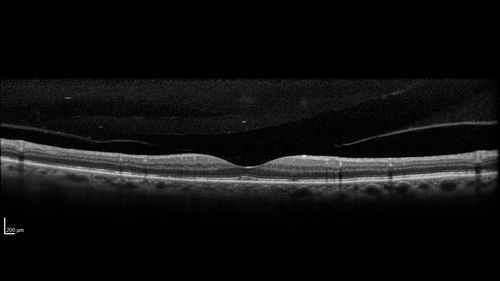 Posterior Scleritis - positive T-sign
62 year ols man was sick about 6 weeks ago and then 2 weeks ago the the left eye got red.  He was treated for conjunctivitis and the eye did not get better.  Topical steroids and oral non-steroidal anti-inflammatory medications did not help.  
VA OD: Dcc20/25 NccJ5
VA OS: Dcc5'/200 
The scleritis cleared within 2 weeks of starting high dose (80 mg) oral steroids.  Blood tests were all negative.

