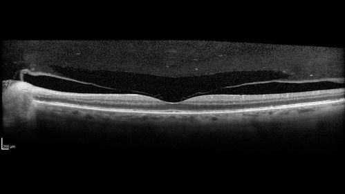 Posterior Scleritis - positive T-sign
62 year ols man was sick about 6 weeks ago and then 2 weeks ago the the left eye got red.  He was treated for conjunctivitis and the eye did not get better.  Topical steroids and oral non-steroidal anti-inflammatory medications did not help.  
VA OD: Dcc20/25 NccJ5
VA OS: Dcc5'/200 
The scleritis cleared within 2 weeks of starting high dose (80 mg) oral steroids.  Blood tests were all negative.
