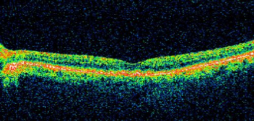Juxtapapillary CNVM and Serous Macular Detachment Wet AMD Rx Laser
85-year-old man OD is 20/25, OS is 20/100.  IOP:  OD 21, OS 22.  

OS:   Vertical C/D ratio is 0.1.  There is a posterior vitreous separation.  There is a hemorrhagic pigment epithelial detachment on the superior pole of the optic nerve, extending a disc-and-a-half diameter off the nerve, with adjacent exudates.  There is a serous macular detachment involving the center of the fovea.  

VA improved from 20/100 to 20/50 in four months from laser.
Schlüsselwörter: wet; juxtapapillary;laser;amd;serous;detachment