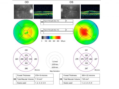 Macular Pucker Post-OP 20/30

