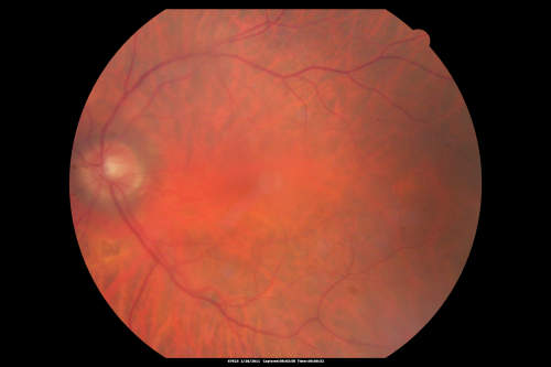 Post-operative photography - vision has improved to 20/50 1 year later.
1 year after scleral buckle vision is 20/50 and patient has a cataract.
