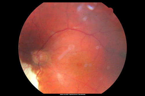 Proleferative Vitreoretinopathy - Panretinal Retinoschisis 

