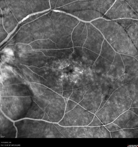Proleferative Vitreoretinopathy - Panretinal Retinoschisis 
Fluorescein Angiogram shows Diffuse Leakage from retinal vessels and CME.
