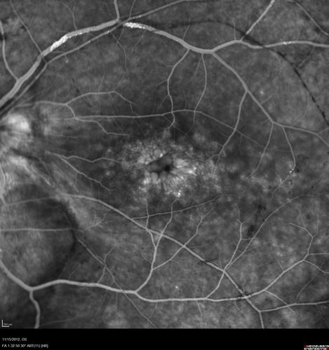 Proleferative Vitreoretinopathy - Panretinal Retinoschisis 
Fluorescein Angiogram shows Diffuse Leakage from retinal vessels and CME.

