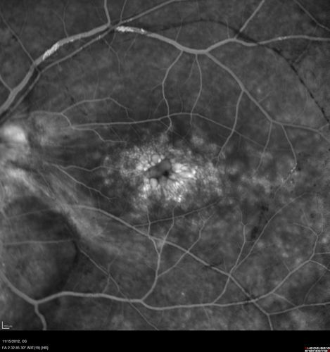 Proleferative Vitreoretinopathy - Panretinal Retinoschisis 
Fluorescein Angiogram shows Diffuse Leakage from retinal vessels and CME.
