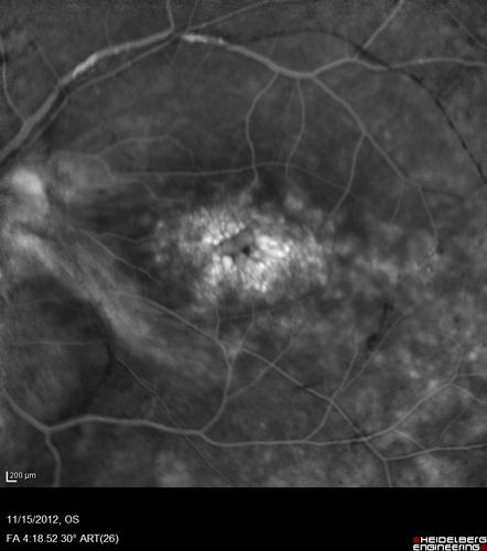 Proleferative Vitreoretinopathy - Panretinal Retinoschisis 
Fluorescein Angiogram shows Diffuse Leakage from retinal vessels and CME.
