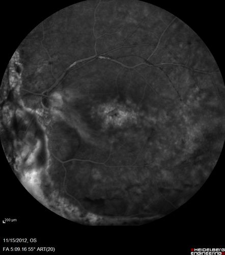 Proleferative Vitreoretinopathy - Panretinal Retinoschisis 
Fluorescein Angiogram shows Diffuse Leakage from retinal vessels and CME.
