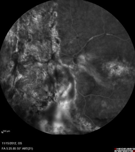 Proleferative Vitreoretinopathy - Panretinal Retinoschisis 
Fluorescein Angiogram shows Diffuse Leakage from retinal vessels and CME.
