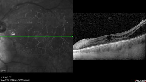 Proleferative Vitreoretinopathy - Panretinal Retinoschisis 
