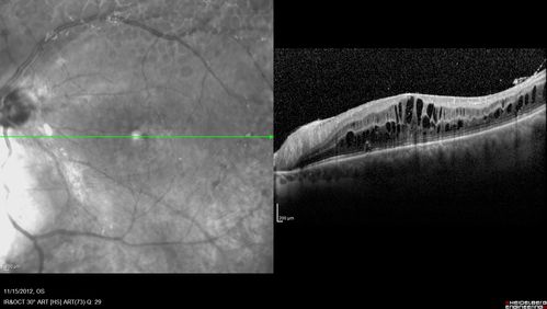 Proleferative Vitreoretinopathy - Panretinal Retinoschisis 
