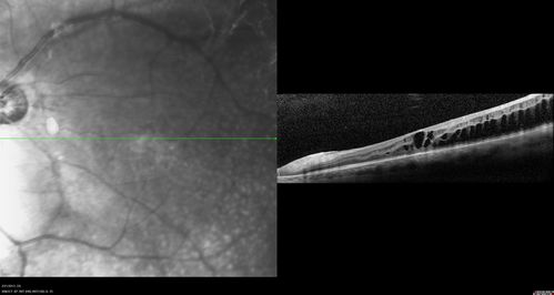 Proleferative Vitreoretinopathy - Panretinal Retinoschisis 
