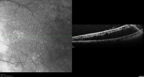 Proleferative Vitreoretinopathy - Panretinal Retinoschisis 
