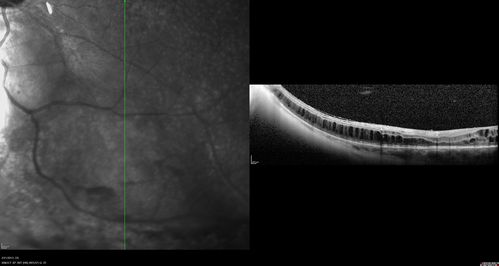 Proleferative Vitreoretinopathy - Panretinal Retinoschisis 
