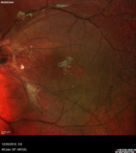 Proleferative Vitreoretinopathy - Panretinal Retinoschisis 
