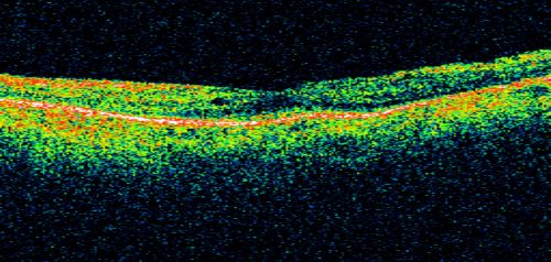 Acute Zonal Occult Outer Retinopathy with Severe Peripheral Vision Loss Left Eye Post Treatment for CME
 58-year-old man developed a peripheral vision problem about 25 years ago.   OD 20/30, OS 20/40.
Schlüsselwörter: azoor;bone spicules;retinitis pigmentosa;rp;pseudo