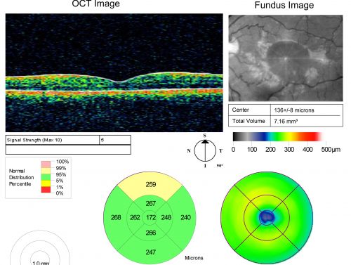 Chronic Central Serous Retinopathy treated with Photodynamic Laser and Visudyne
48-year-old man has had waxing and waning vision in the left eye for the last year from central serous retinopathy. OD is 20/16, OS is 20/16 - 2 months post PDT therapy with Visudyne.
