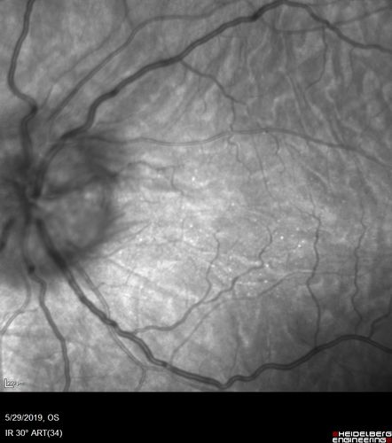 Posterior Scleritis - and Optic nerve swelling and vision loss to HM left eye
2 month following resolution on 80 mg prednisone, with taper now at 10 mg prednisone daily, the vision in the left eye has dropped to HM
