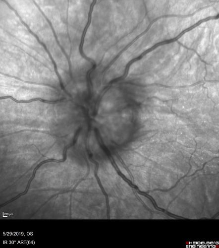 Posterior Scleritis - and Optic nerve swelling and vision loss to HM left eye
2 month following resolution on 80 mg prednisone, with taper now at 10 mg prednisone daily, the vision in the left eye has dropped to HM
