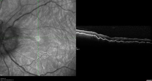 Posterior Scleritis - and Optic nerve swelling and vision loss to HM left eye
2 month following resolution on 80 mg prednisone, with taper now at 10 mg prednisone daily, the vision in the left eye has dropped to HM
