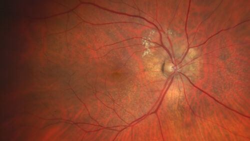 Peripapillary CNVM No Treatment
85 year old with peripapillary CNVM watched for many years.

