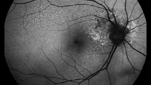 Peripapillary CNVM No Treatment
85 year old with peripapillary CNVM watched for many years.
