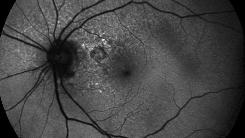 Peripapillary CNVM No Treatment
85 year old with peripapillary CNVM watched for many years.
