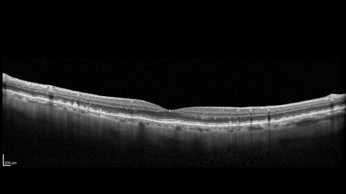 Peripapillary CNVM No Treatment
85 year old with peripapillary CNVM watched for many years.
