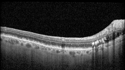 Peripapillary CNVM No Treatment
85 year old with peripapillary CNVM watched for many years.
