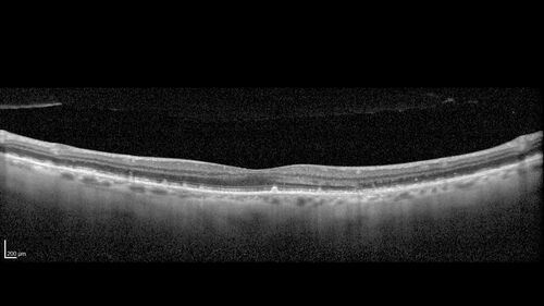 Peripapillary CNVM No Treatment
85 year old with peripapillary CNVM watched for many years.
