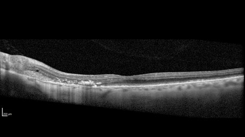 Peripapillary CNVM No Treatment
85 year old with peripapillary CNVM watched for many years.
