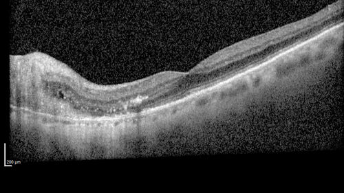 Peripapillary CNVM No Treatment
85 year old with peripapillary CNVM watched for many years.
