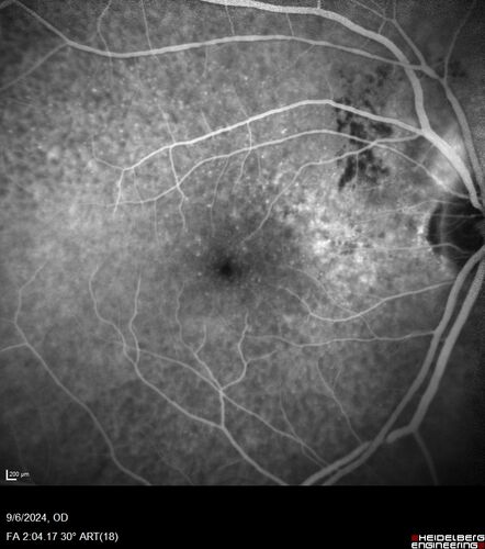 Peripapillary CNVM No Treatment
85 year old with peripapillary CNVM watched for many years.

