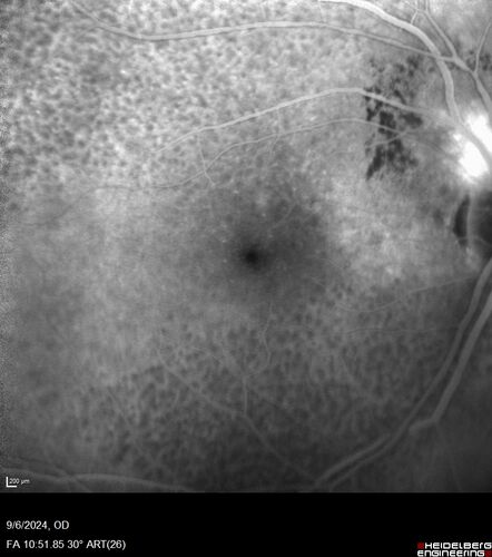 Peripapillary CNVM No Treatment
85 year old with peripapillary CNVM watched for many years.
