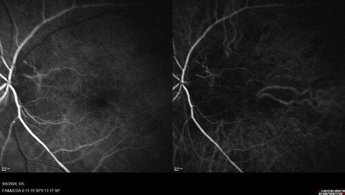 Peripapillary CNVM No Treatment
85 year old with peripapillary CNVM watched for many years.
